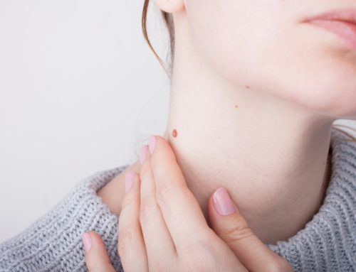 Eliminación de Verrugas